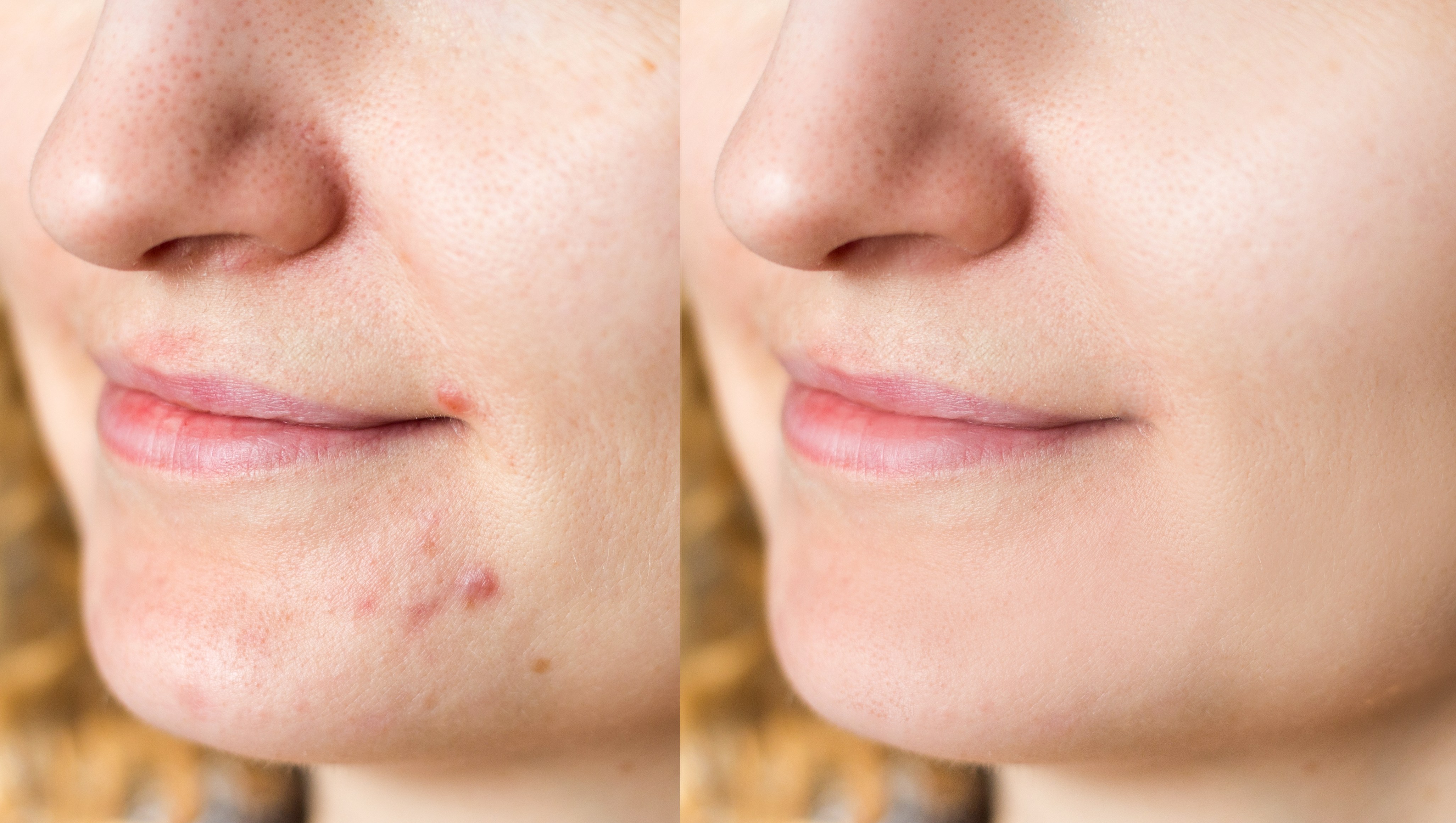 Breakouts? Reviewers Say These $6 Patches 'Reduce Pimples Overnight'