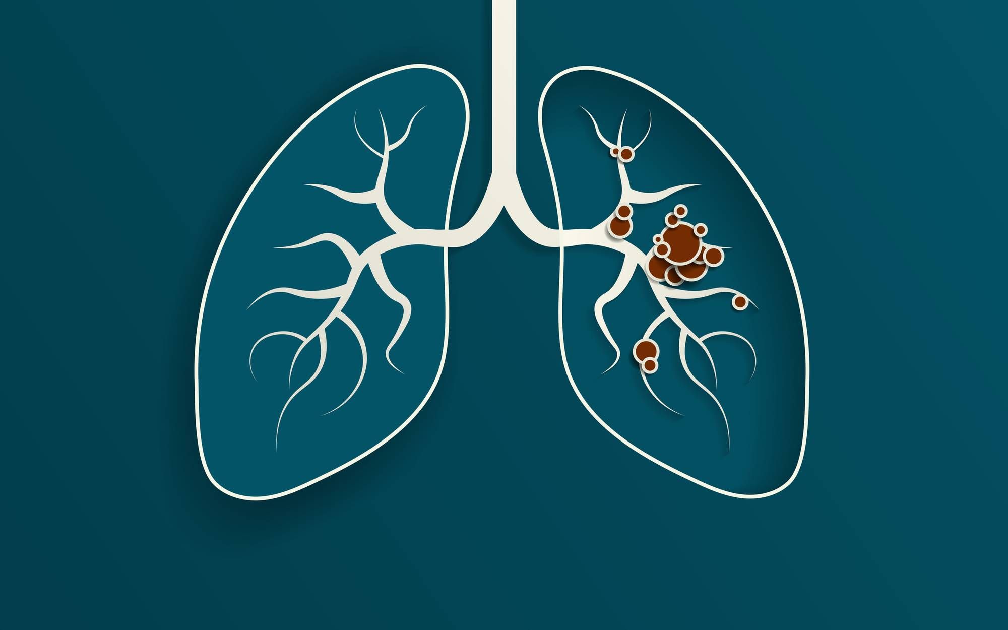 How Do Lung Cancer Biomarkers Help Guide Treatment?