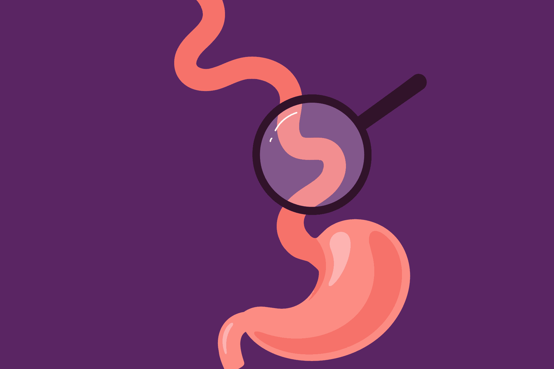 Understanding and Managing Eosinophilic Esophagitis (EoE)