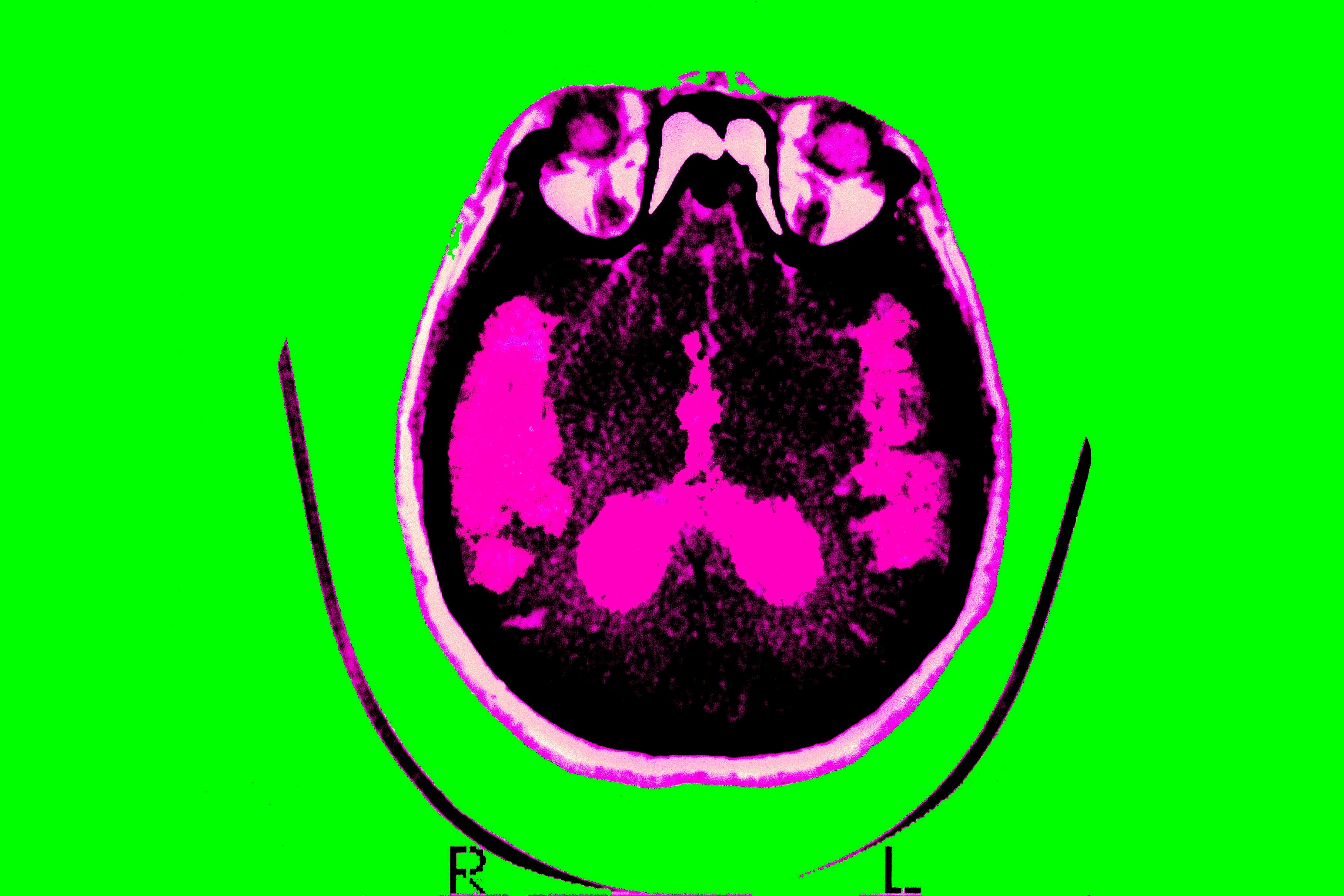 Scientists are finally starting to figure out Alzheimer’s