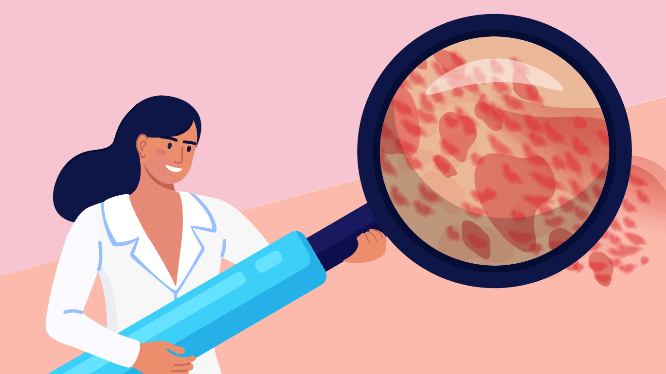 What Is Chronic Spontaneous Urticaria??
