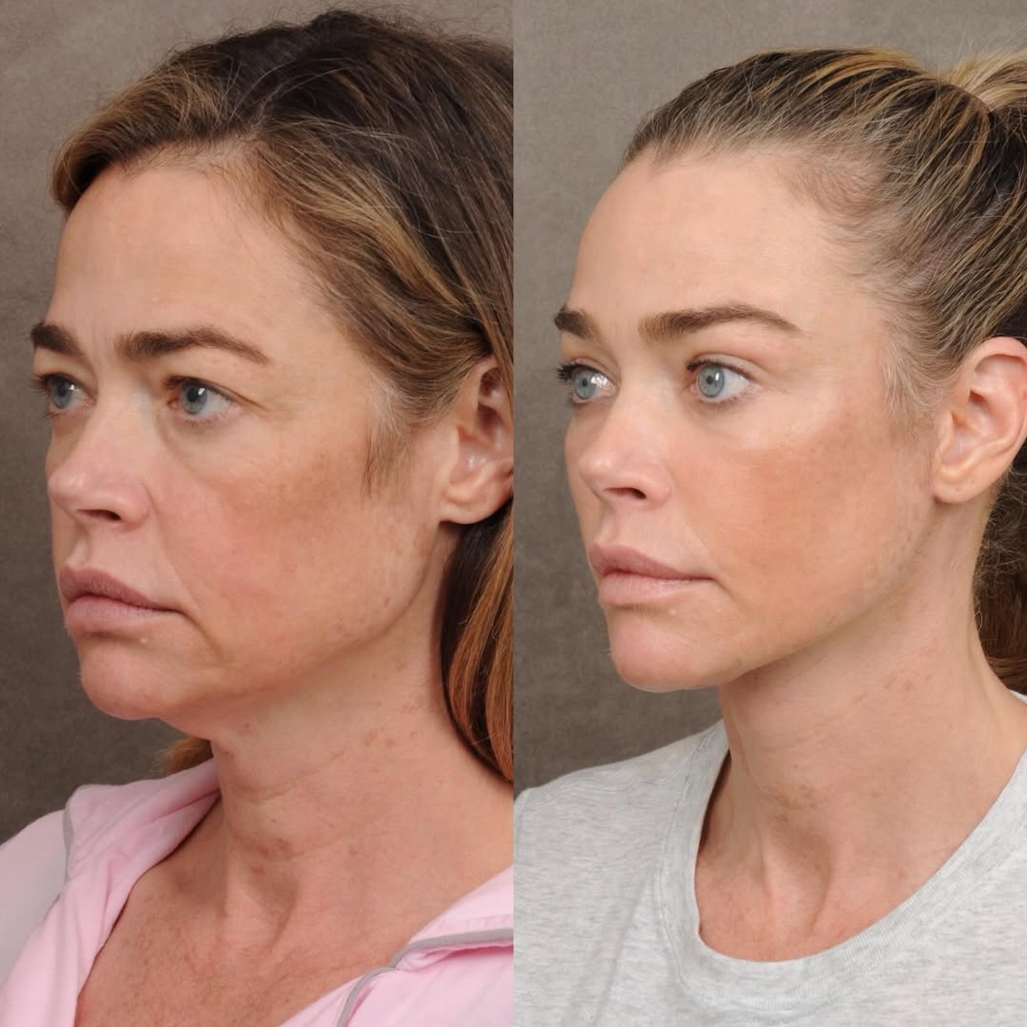 Denise Richards Reveals Jaw-Dropping Before-and-After Facelift Photos