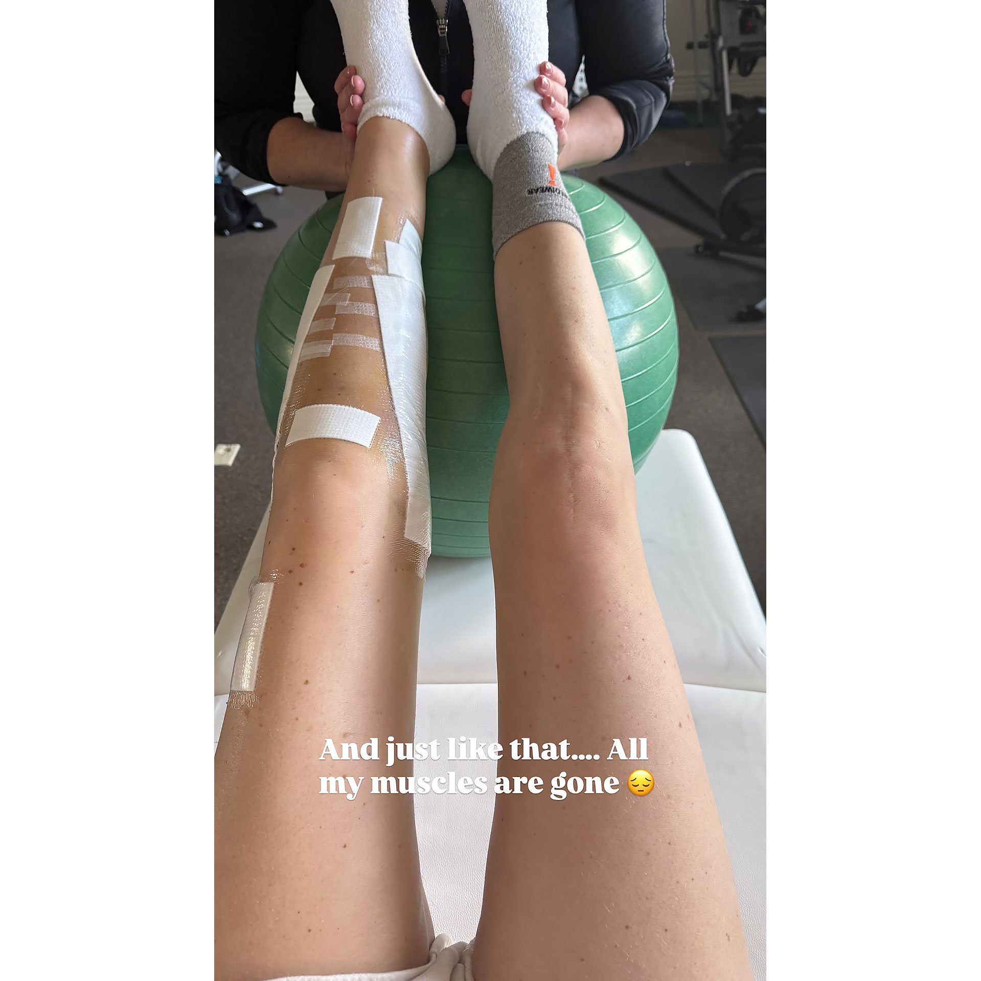 Lindsey Vonn Shares Dramatic Picture of Her Legs After Multiple Surgeries