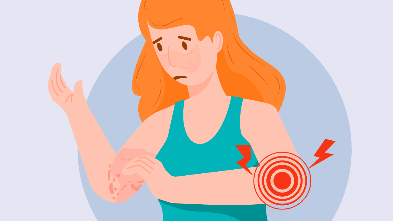 Lupus Triggers
