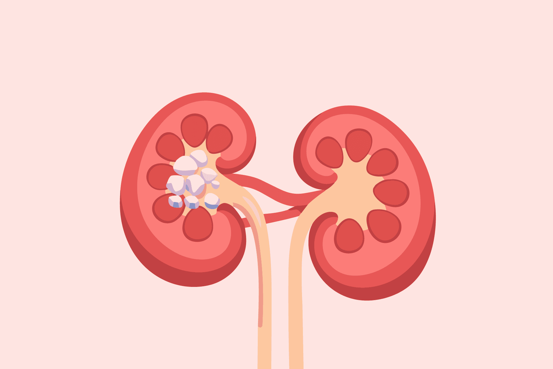 Treating Primary Hyperoxaluria