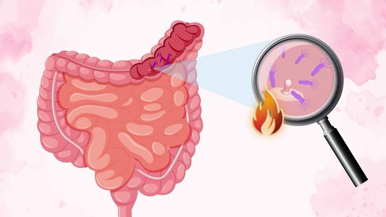How Your Gut Microbiome Affects Your Colorectal Cancer Risk