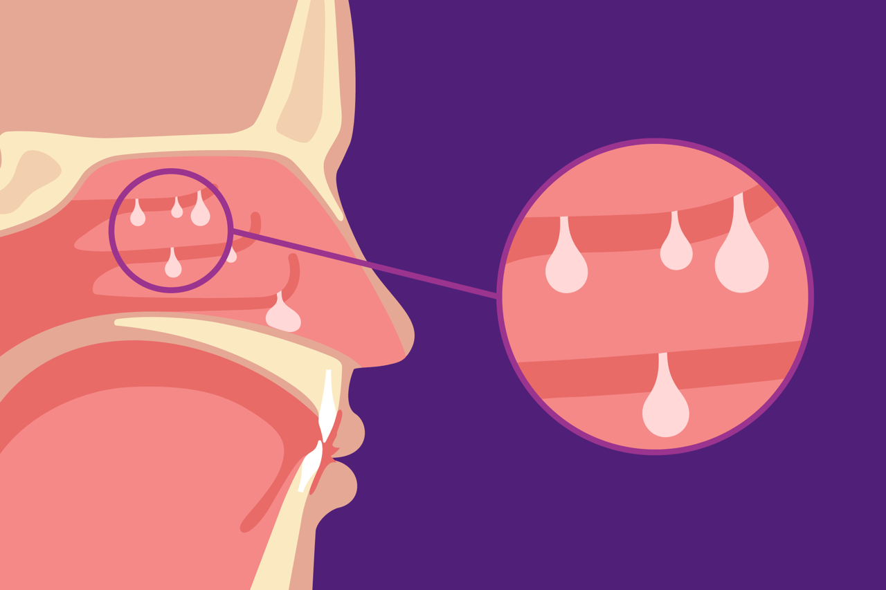 What’s the Connection? Nasal Polyps and Coexisting Conditions