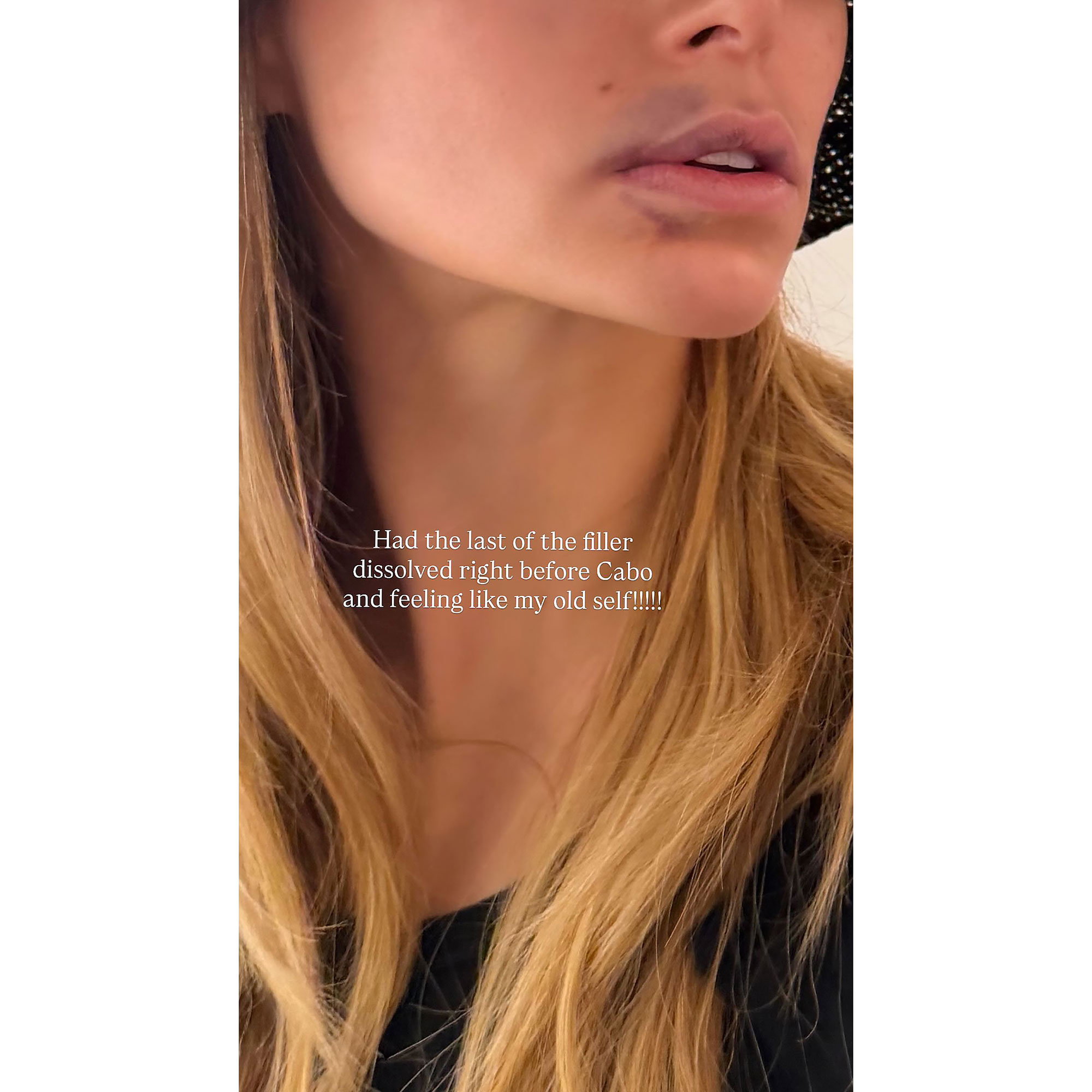 Brooks Nader Shows Off Her Smaller Pout After Dissolving Lip Filler