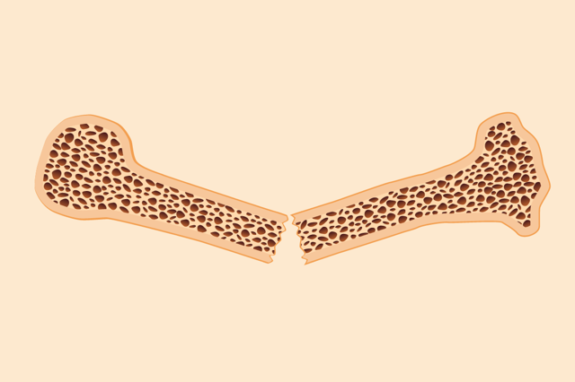 What Is Osteoporosis and How Do You Treat It?