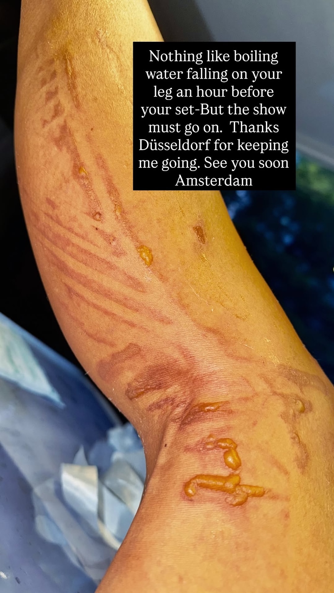 Nicole Scherzinger Shares Gruesome Pic After Boiling Water Fell on Her Leg