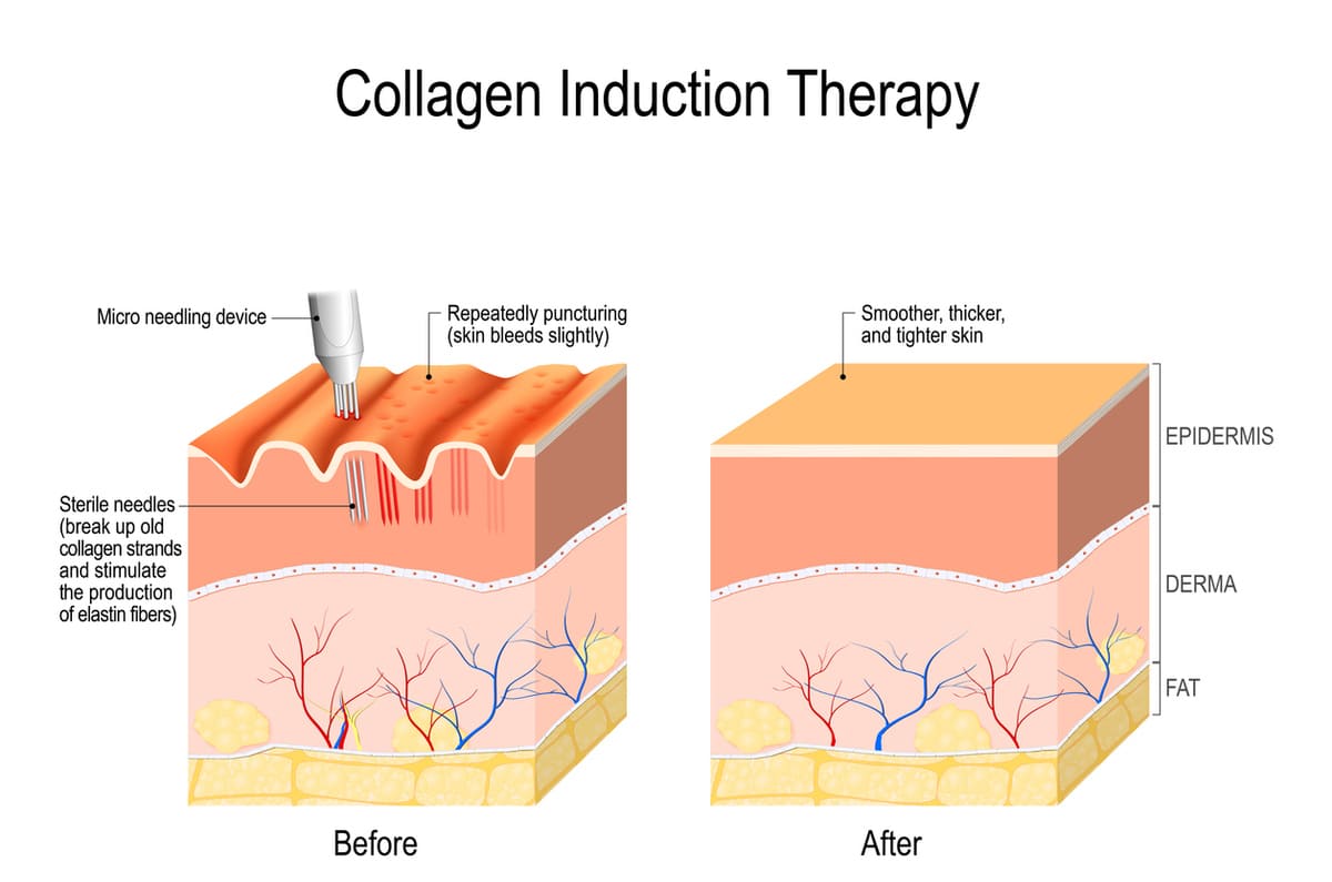 A Step-By-Step Guide to Microneedling at Home