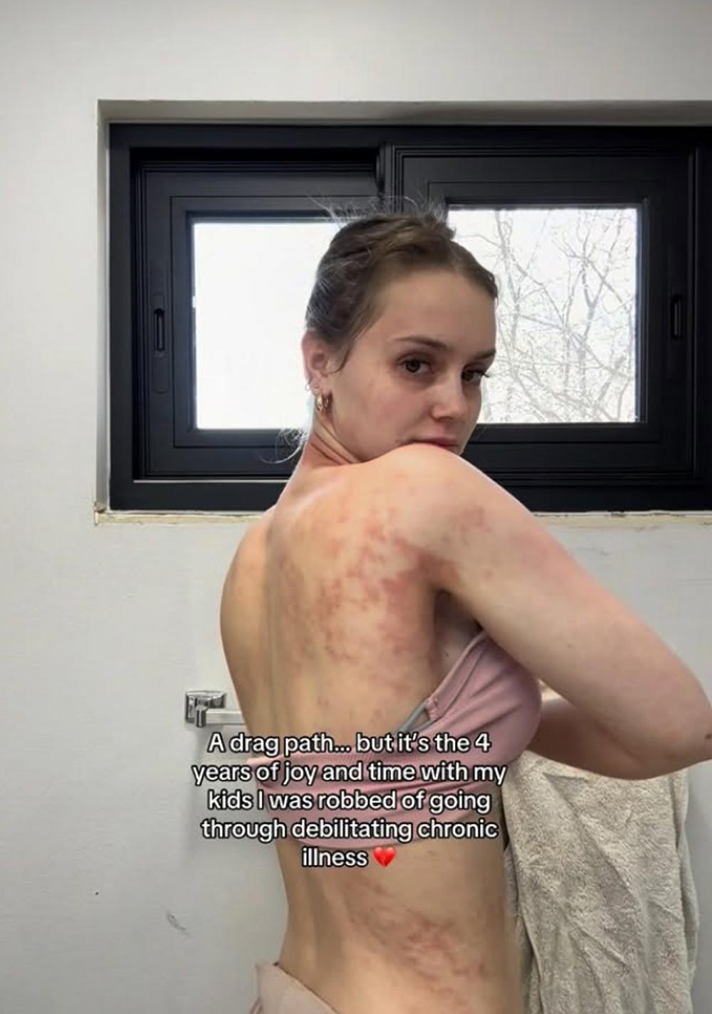 Mikayla Matthews Claps Back at People ‘Minimizing’ Her Chronic Skin Condition