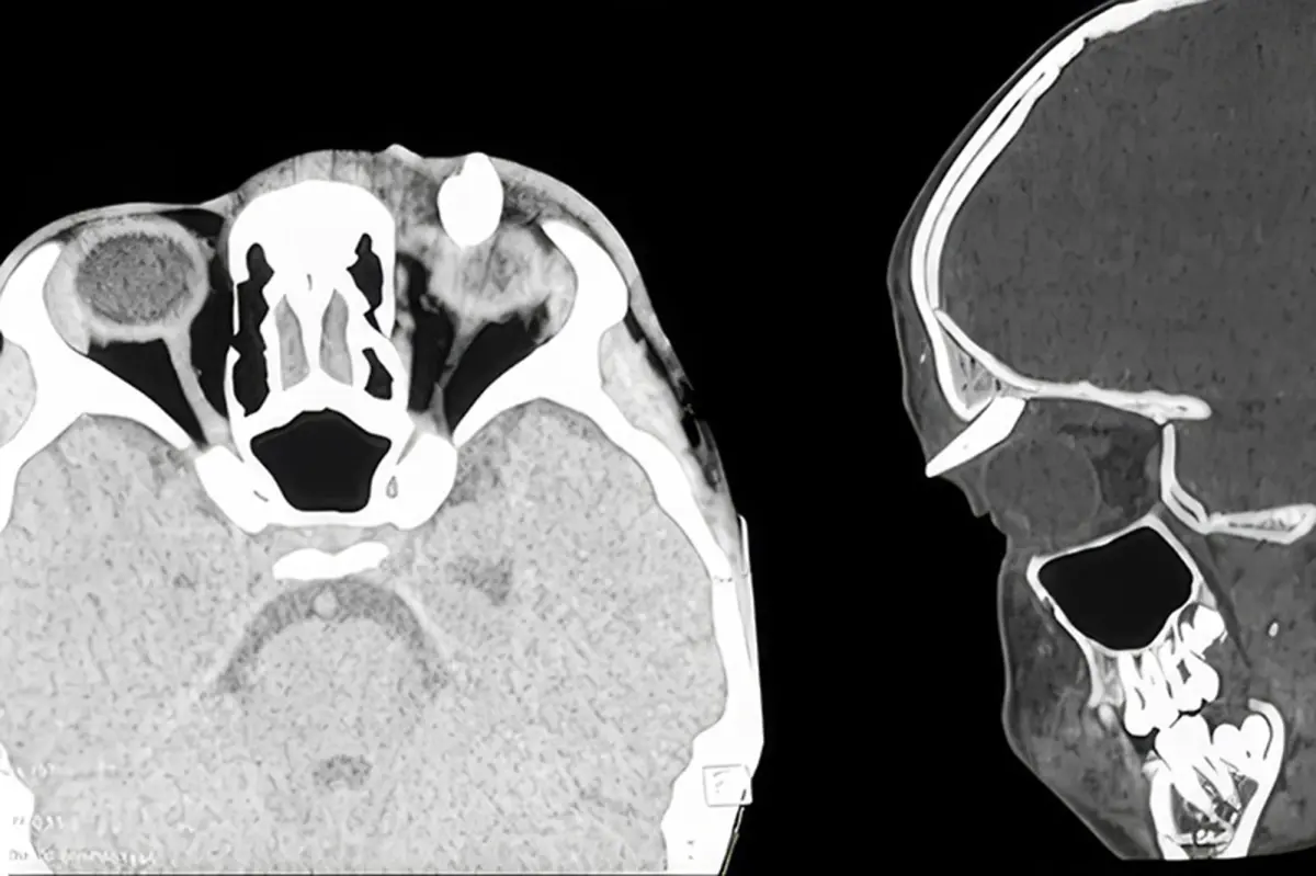 The Unusual Case of Ectopic Teeth: A Tooth in the Eye Socket